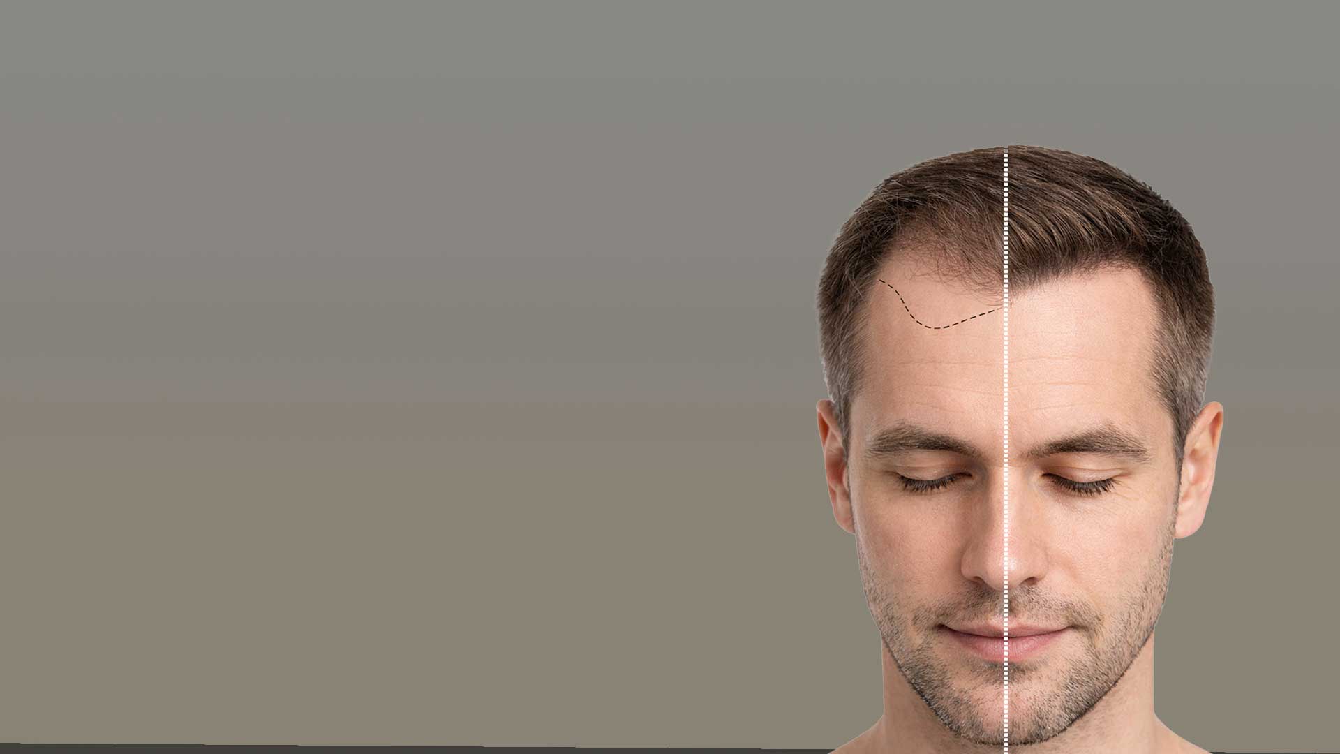 Коррекция пересадки волос