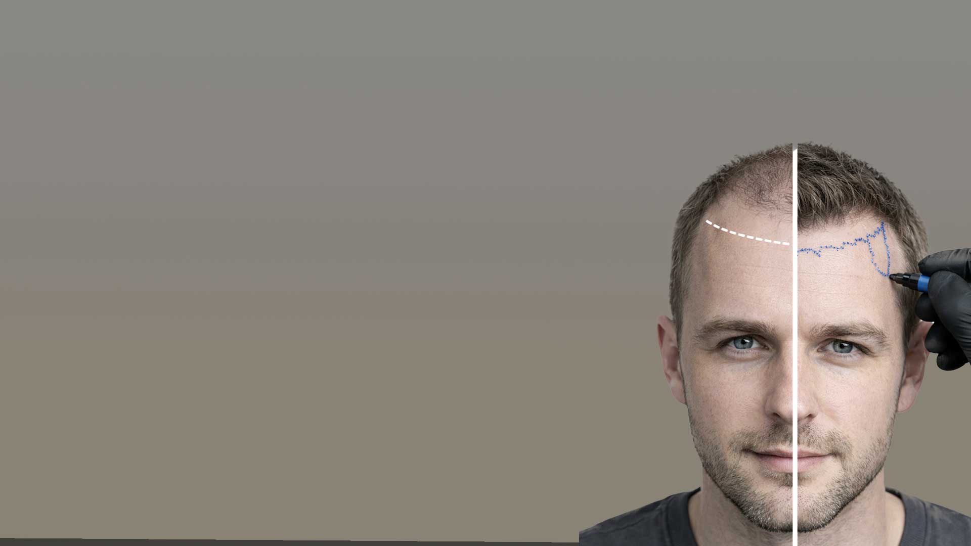 Линия роста волос